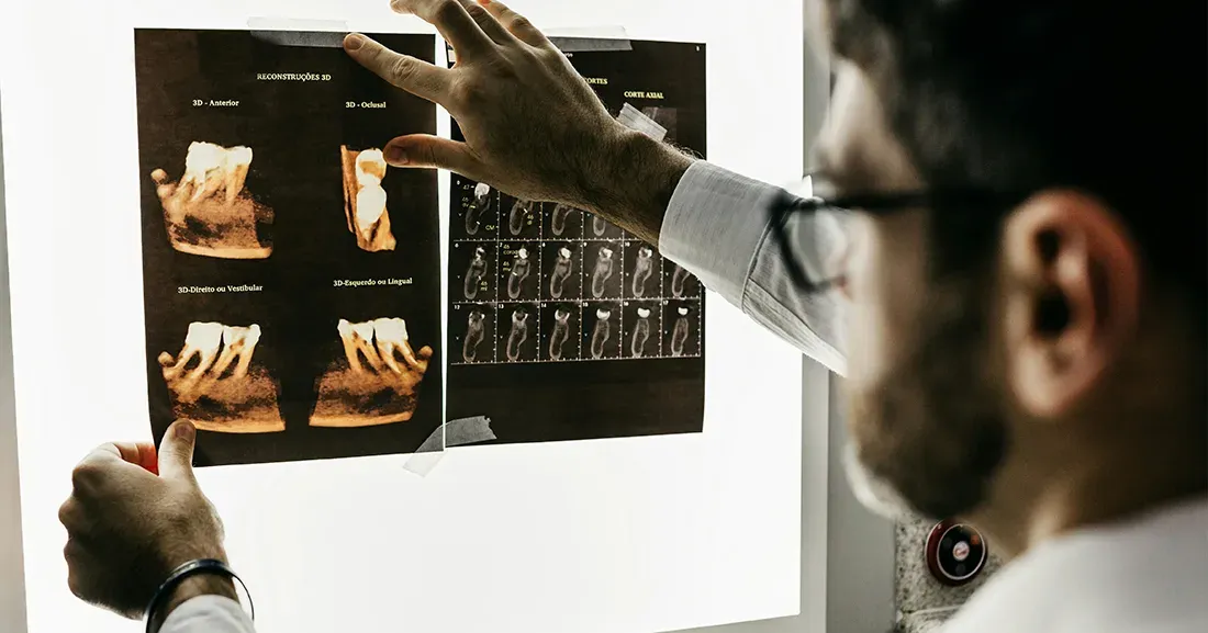 Implantologia zigomatica: una soluzione per tornare ad avere denti fissi anche con poco osso
