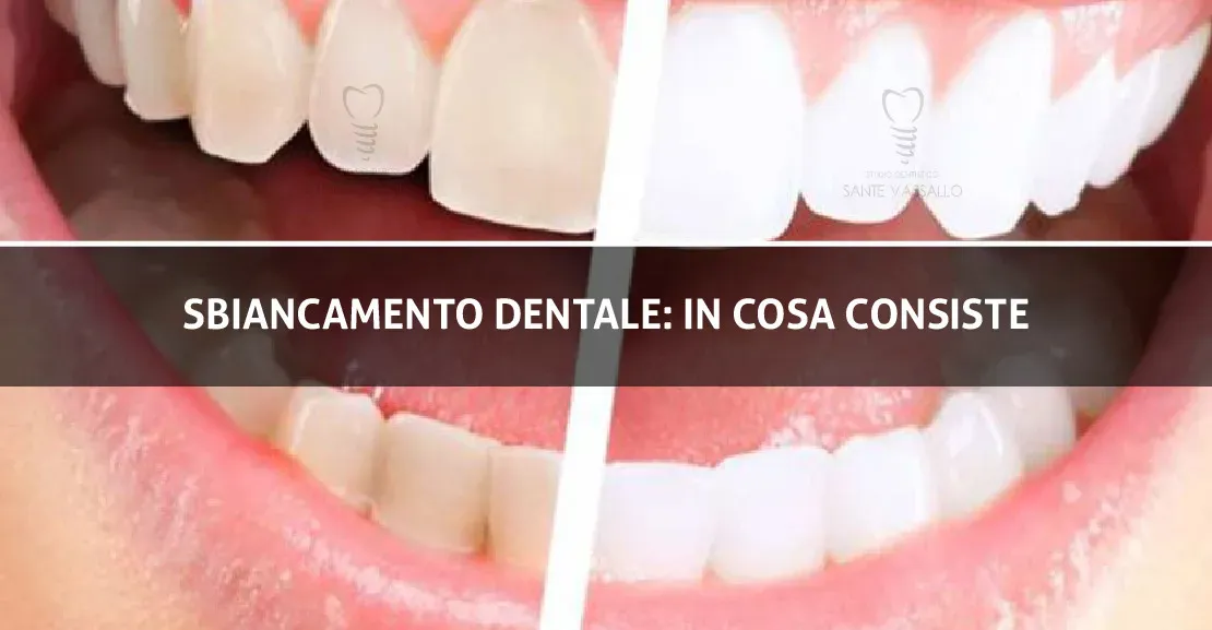 Sbiancamento dentale: in cosa consiste