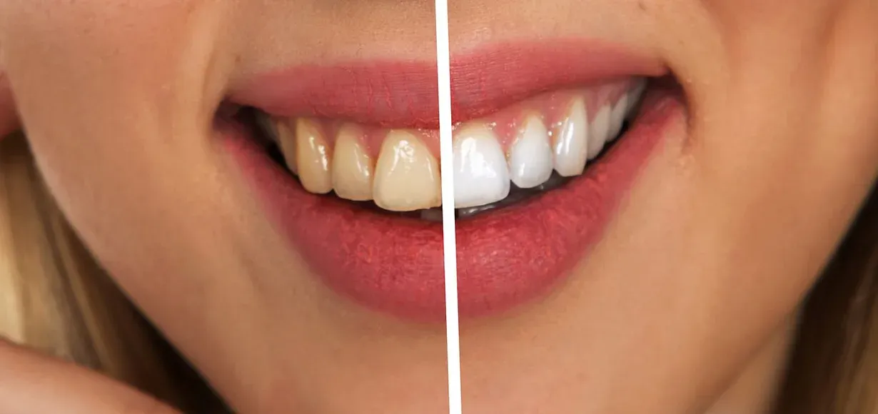 Colore dei denti: perché cambia?