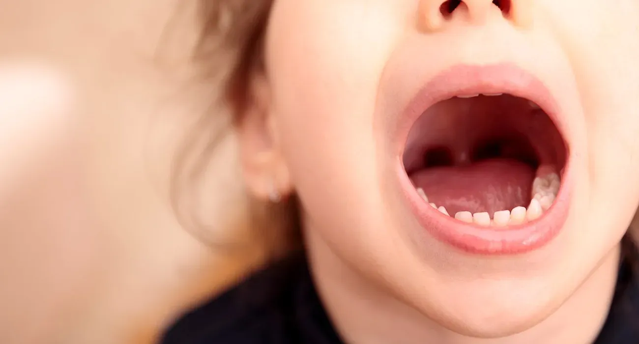 carie-nei-bambini