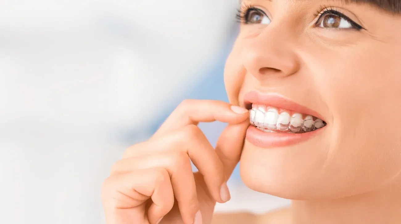 I vantaggi della tecnica Invisalign