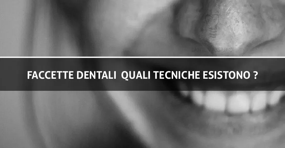 Faccette Dentali Quali tecniche esistono?