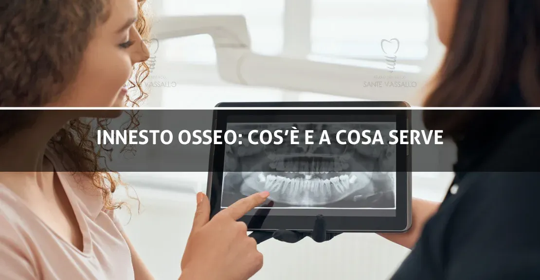 Innesto Osseo Dentale 2 - Studio Dentistico Sante Vassallo