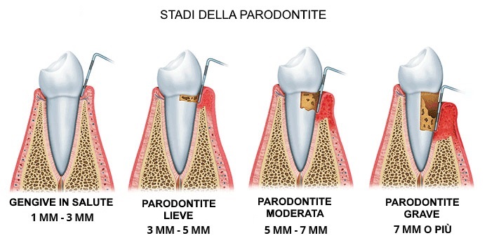 Parodontite | Studio Dentistico Sante Vassallo