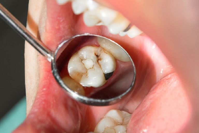 I tipi di carie ai denti più diffusi da conoscere | Studio Dentistico