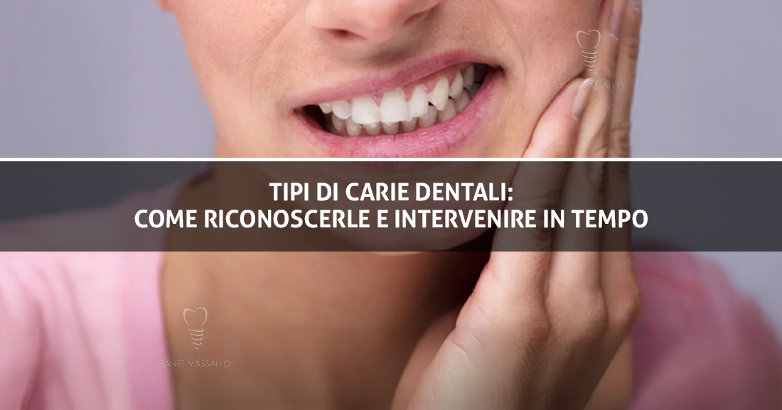 Tipi di carie dentali come riconoscerle e intervenire in tempo Sante Sito