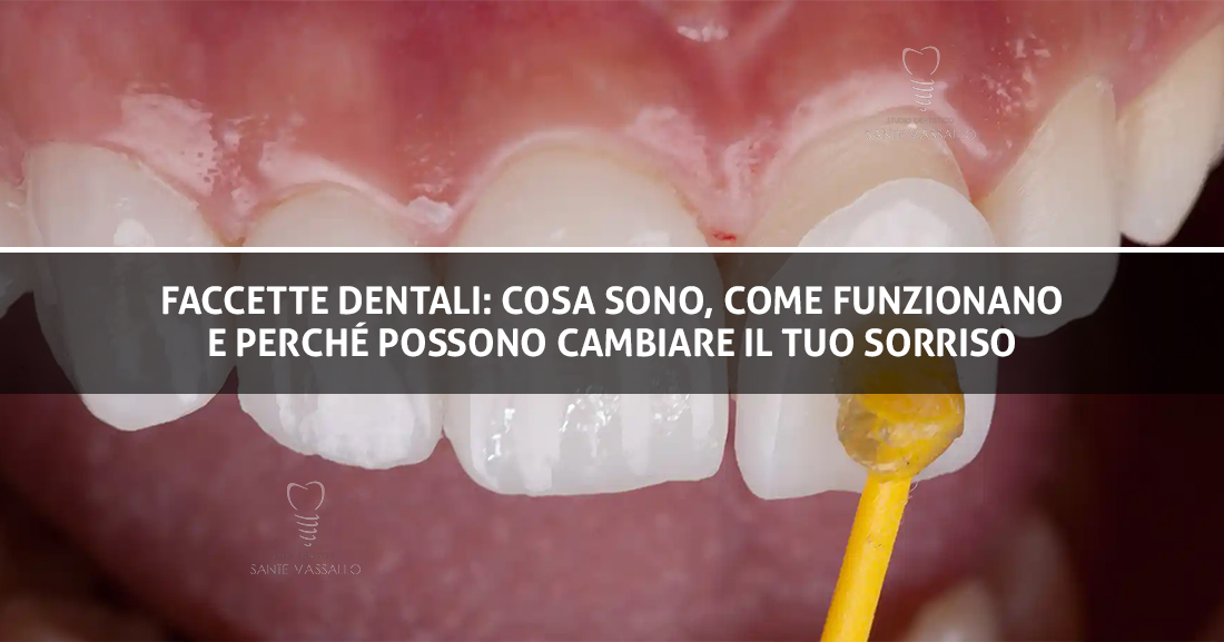 Copertina Blog - Faccette Dentali