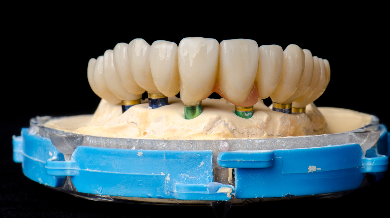 Tipologie di impianto dentale