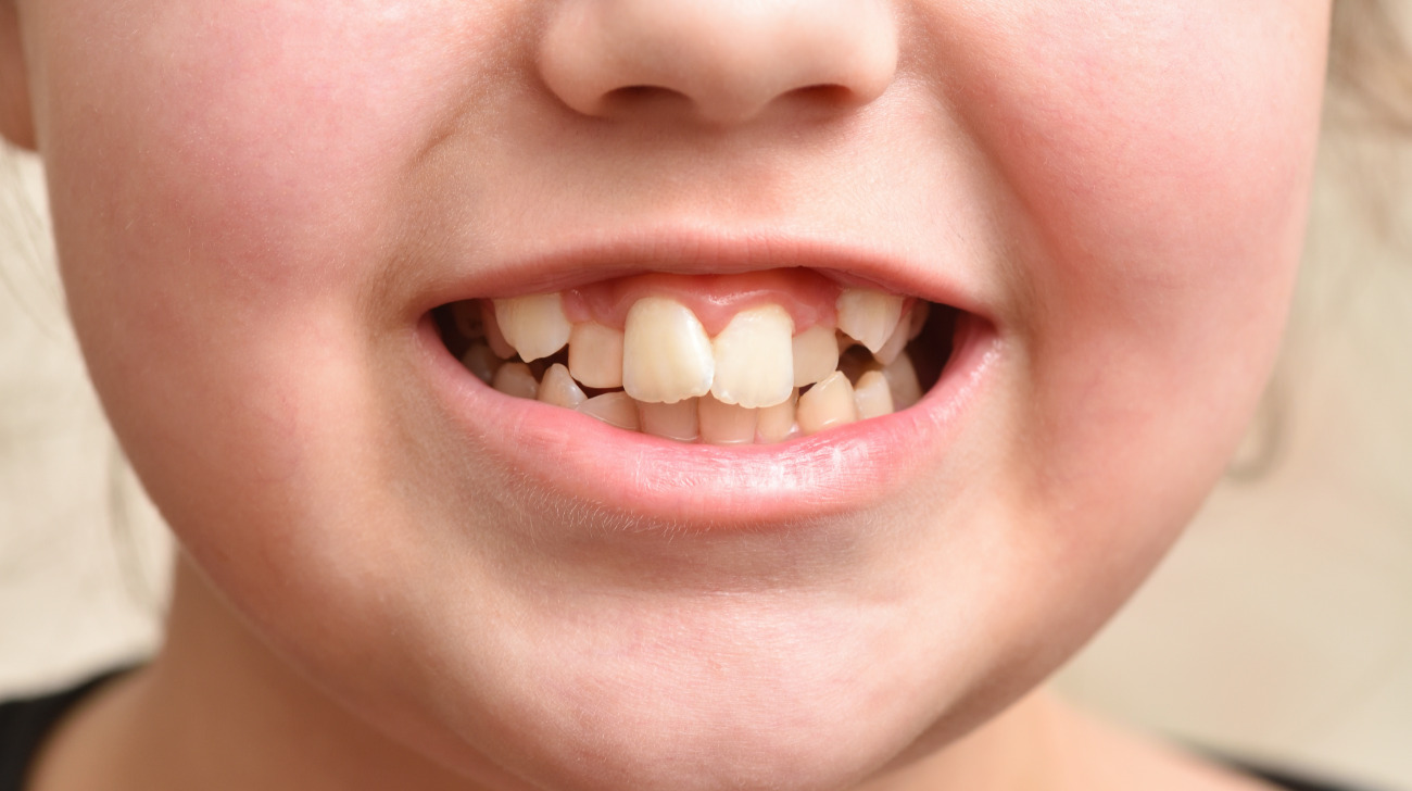 denti storti nei bambini le cause