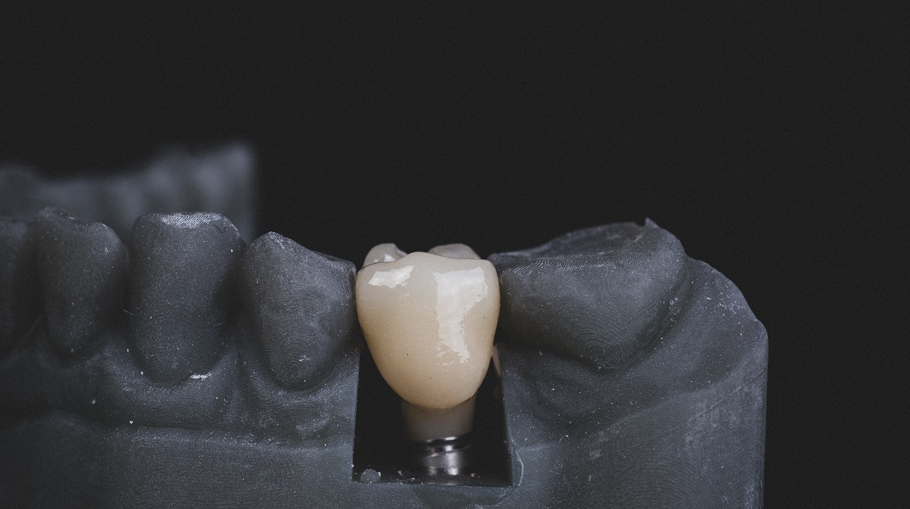 denti fissi in pazienti senza osso