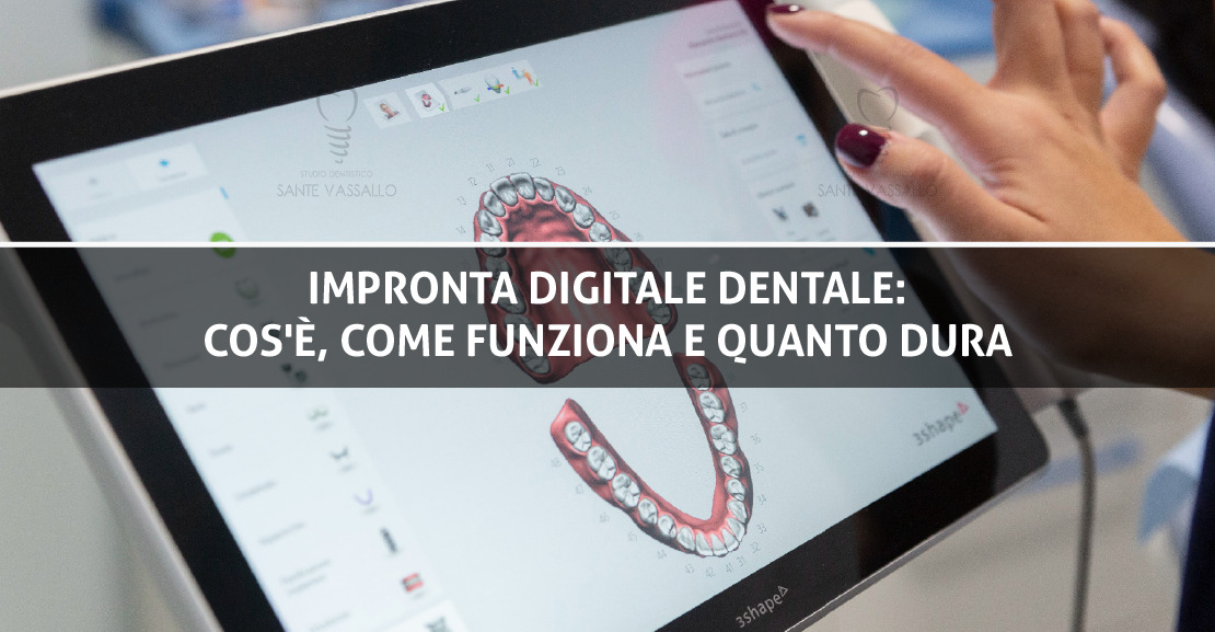 Impronta digitale dentale: cos'è, come funziona e quanto dura - Sante Vassallo