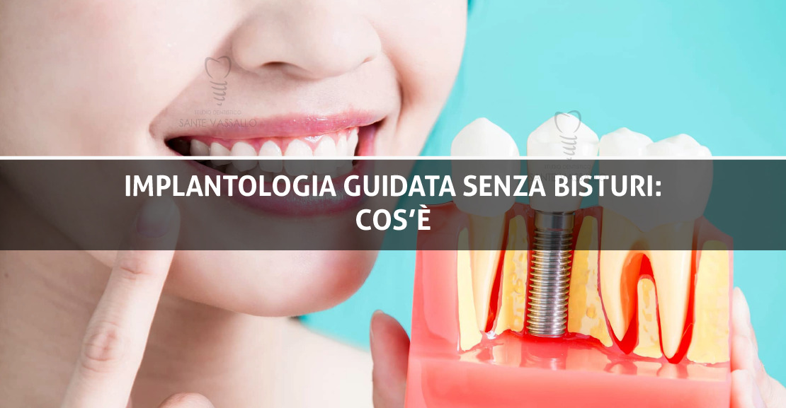 Implantologia dentale senza bisturi - Studio Dentistico Sante Vassallo