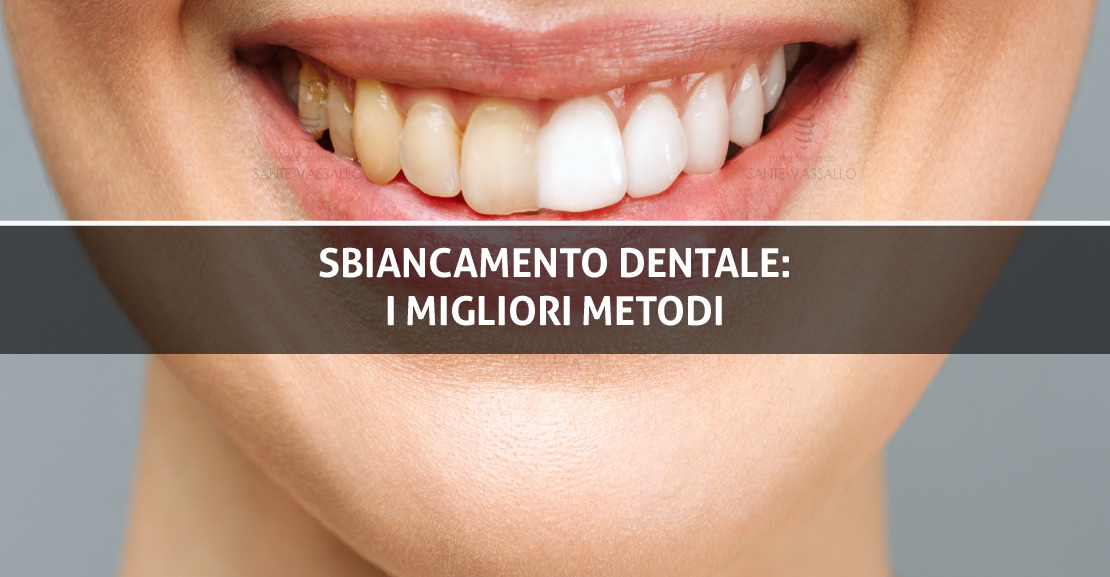 Sbiancamento dentale: I migliori metodi - Studio Dentistico Sante Vassallo