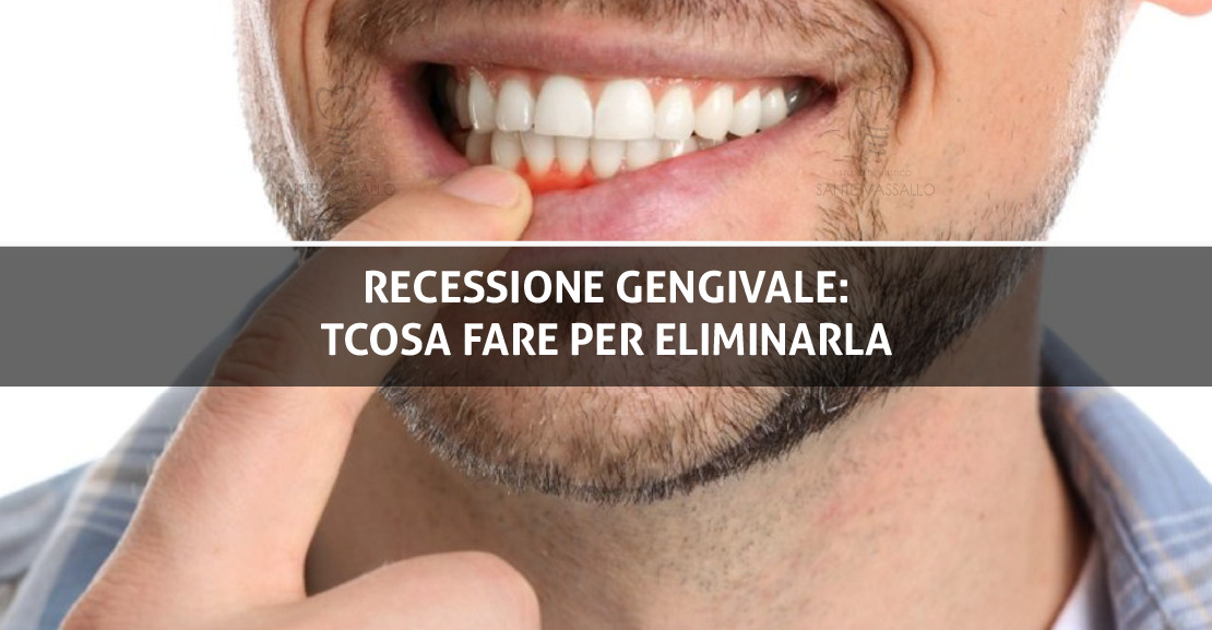 Recessione gengivale: cosa fare per eliminarla - Studio Dentistico Sante Vassallo