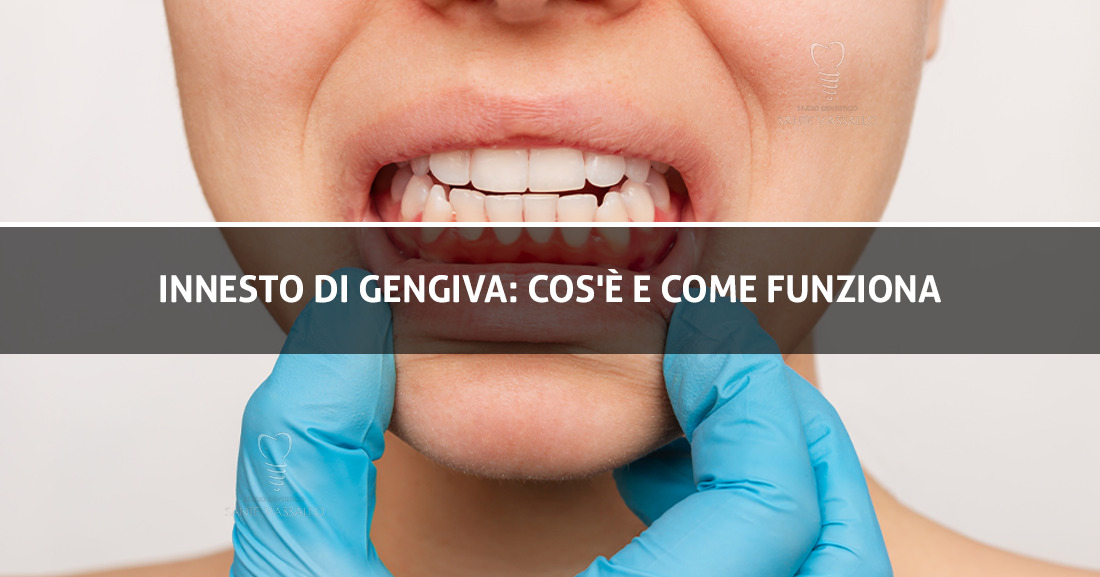Innesto gengivale - Studio Dentistico Sante Vassallo
