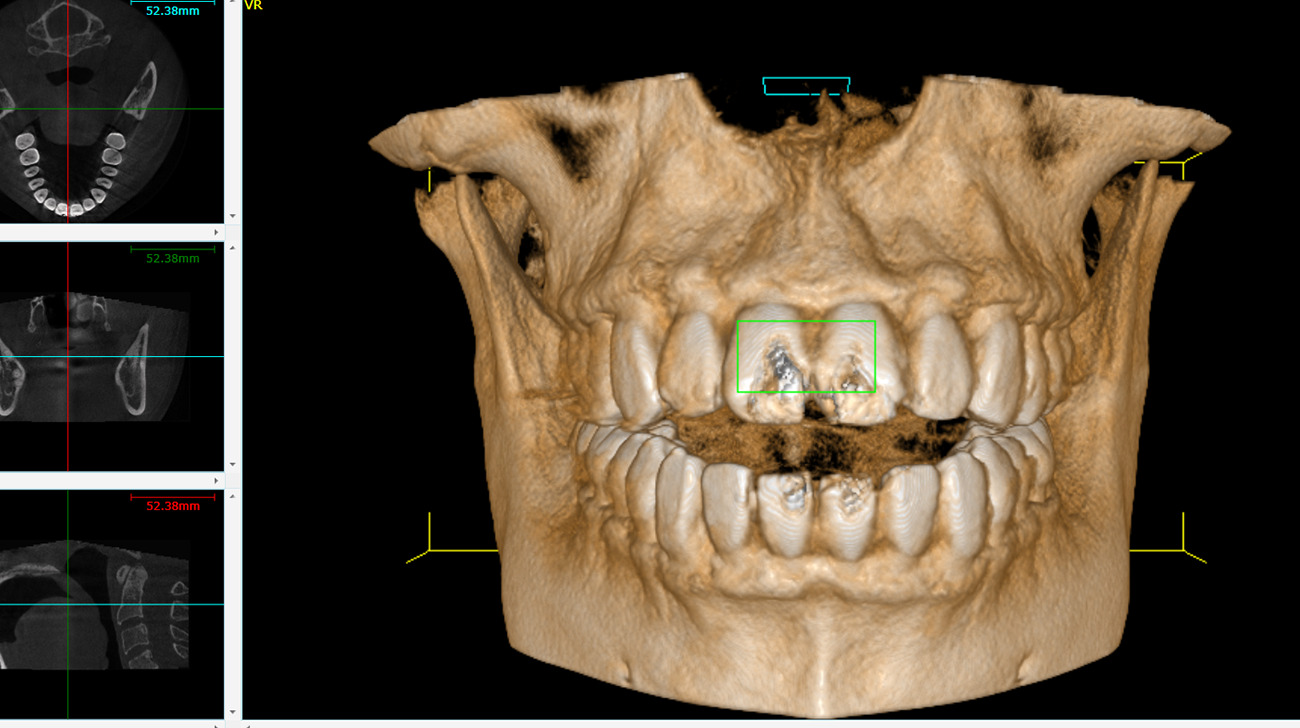 Radiografia dentale e cone beam definizione e differenze tra le due tecniche diagnostiche 2
