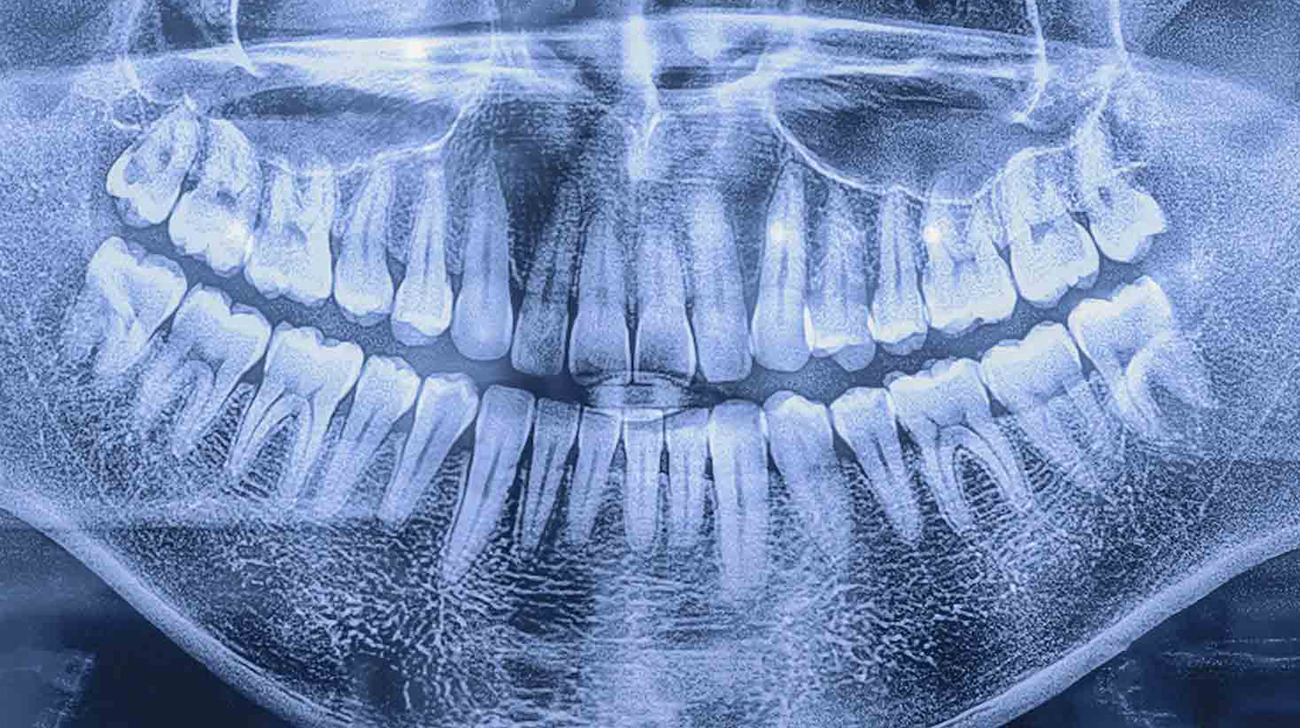 Radiografia dentale e cone beam definizione e differenze tra le due tecniche diagnostiche