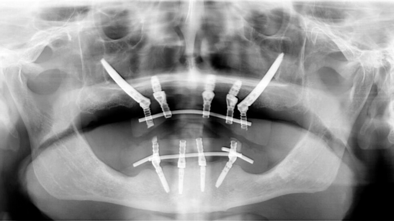 Implantologia zigomatica guidata cos'è e a cosa serve - Studio Dentistico Sante Vassallo - Immagine 2