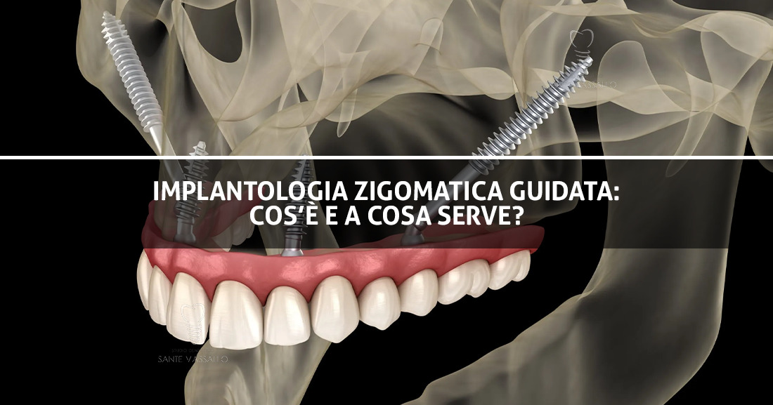 Implantologia zigomatica guidata cos'è e a cosa serve - Studio Dentistico Sante Vassallo