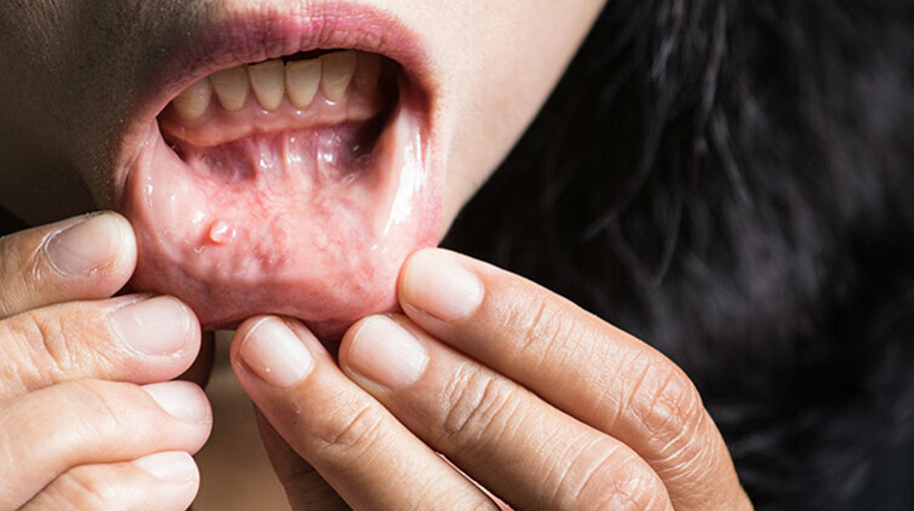 Riconoscere il Tumore alla Bocca Sintomi, Prevenzione e Cure - Immagine 1 - Studio Dentistico Sante Vassallo