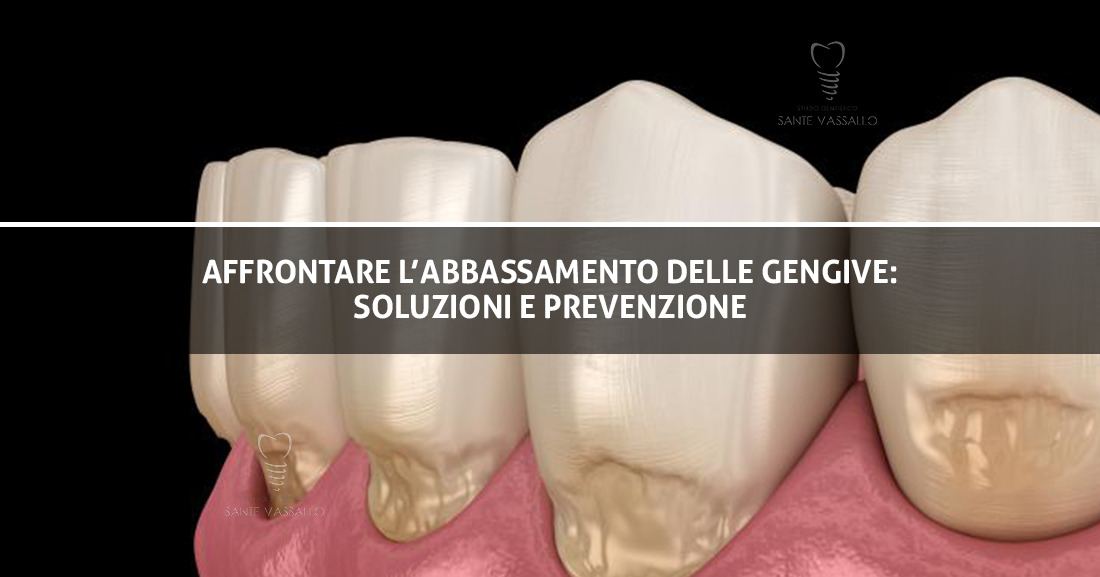 Affrontare l'abbassamento delle gengive - Immagine copertina articolo - Studio Dentistico Sante Vassallo