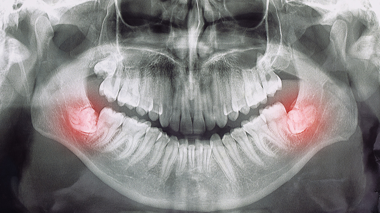 Dente del giudizio - Studio Dentistico Sante Vassallo - Immagine 1 di 2