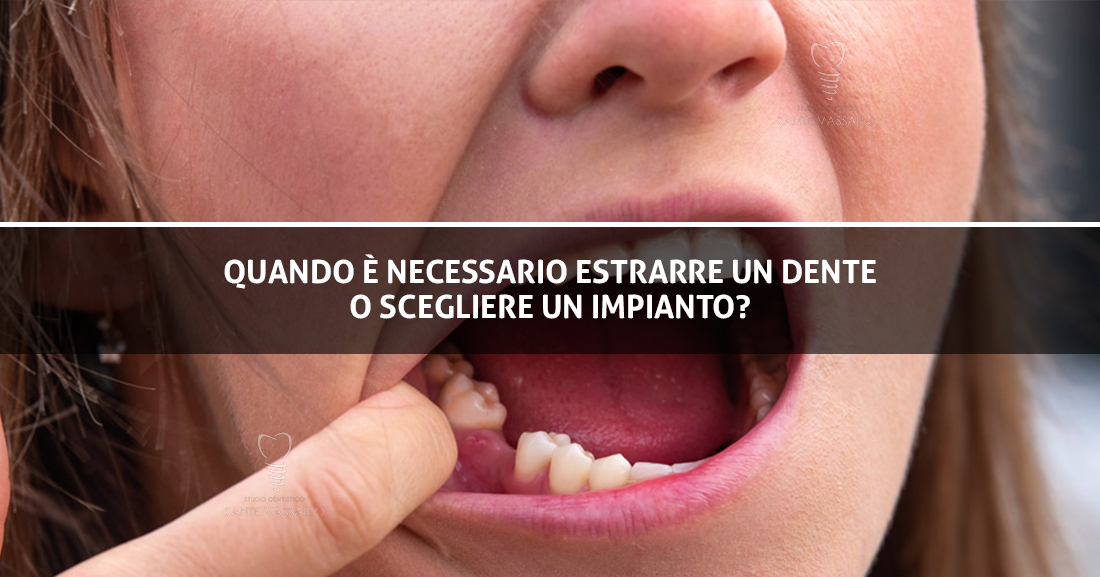 Copertina Blog - Estrazione dente e impianto - Studio Dentistico Sante Vassallo