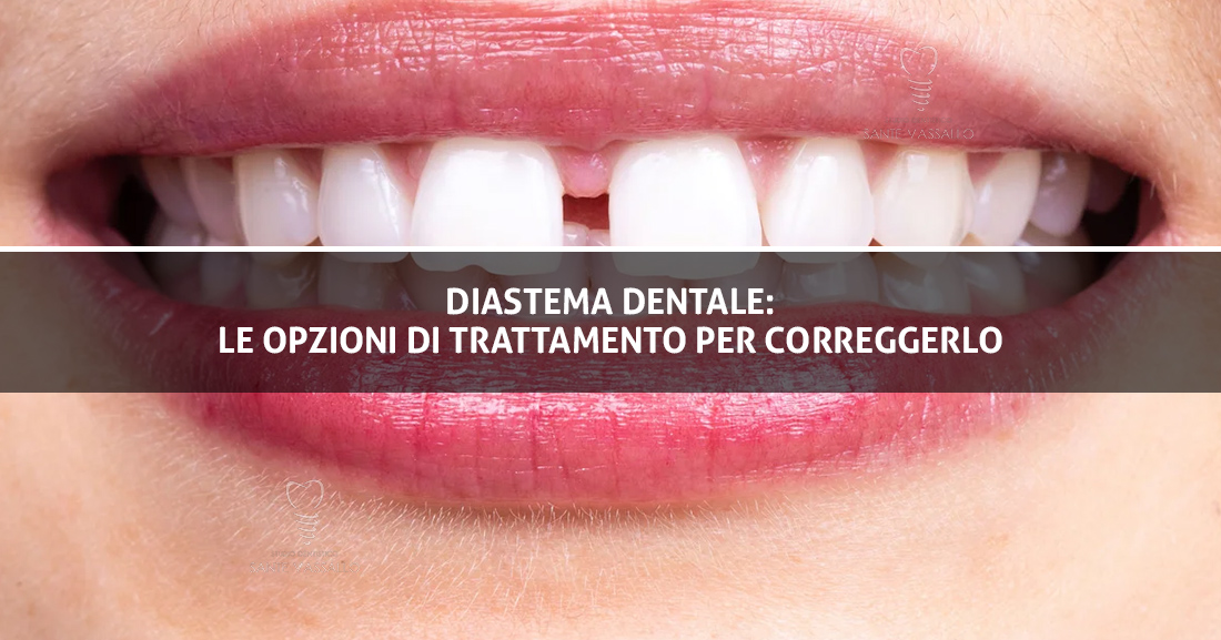 Diastema dentale - Studio Dentistico Sante Vassallo - Copertina Blog