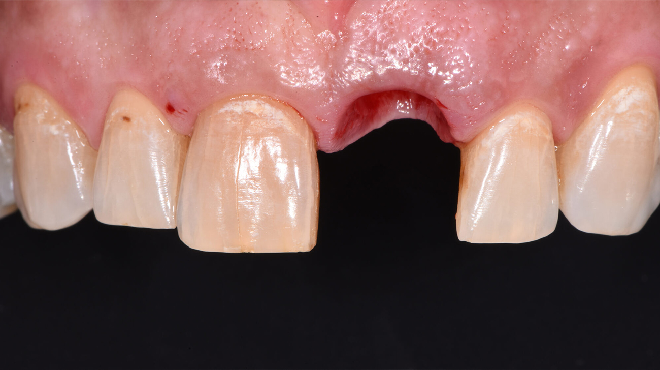 Immagine 1 - Estrazione dente e impianto - Studio Dentistico Sante Vassallo