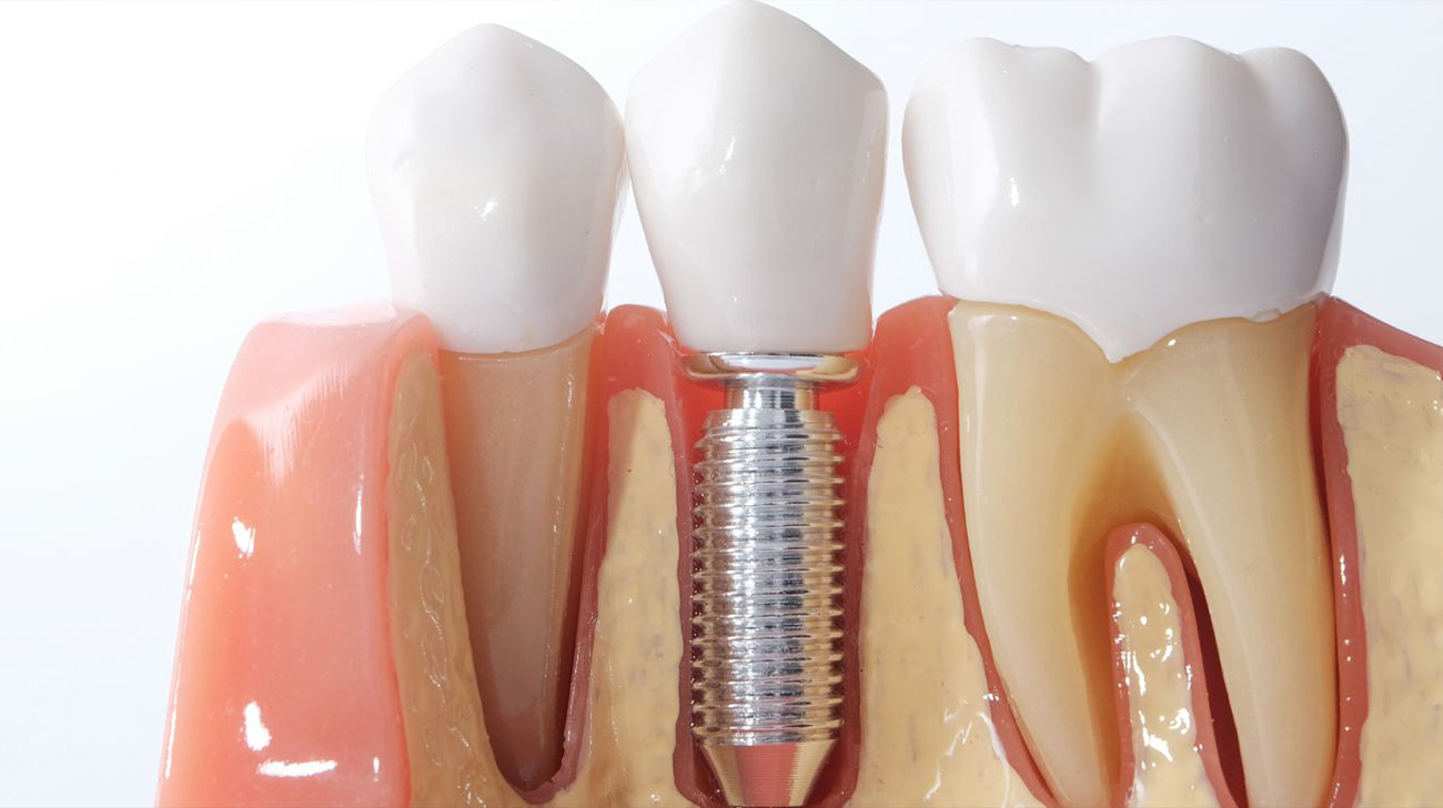 Immagine 2 - Estrazione dente e impianto - Studio Dentistico Sante Vassallo