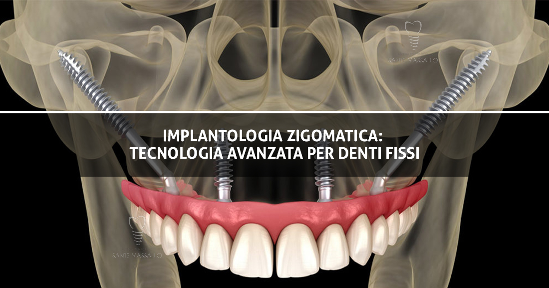 Copertina-Blog Implantologia zigomatica: tecnologia avanzata per denti fissi