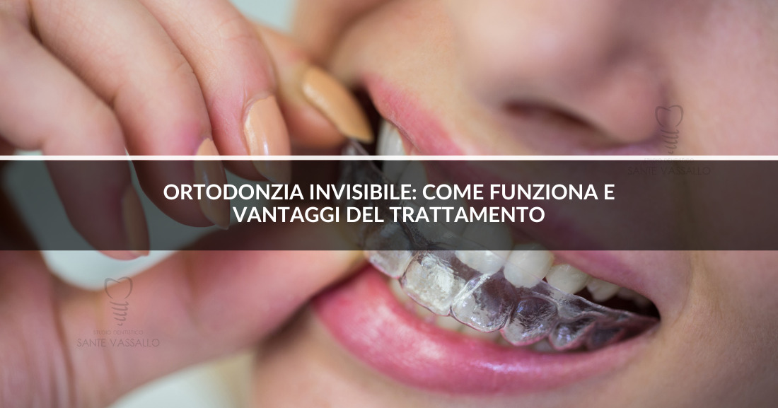 donna-con-mascherina-invisibile- Studio Dentistico Sante Vassallo- ortodonzia-invisibile