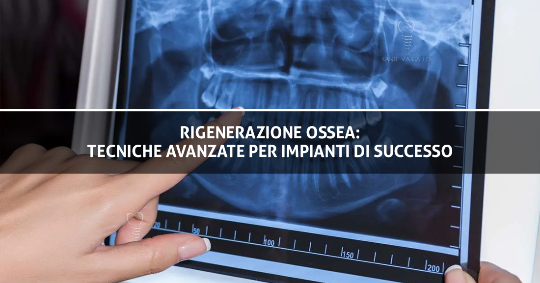 Rigenerazione Ossea Dentale tecniche avanzate per impianti di successo