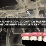 Implantologia Zigomatica Salerno La soluzione Definitiva
