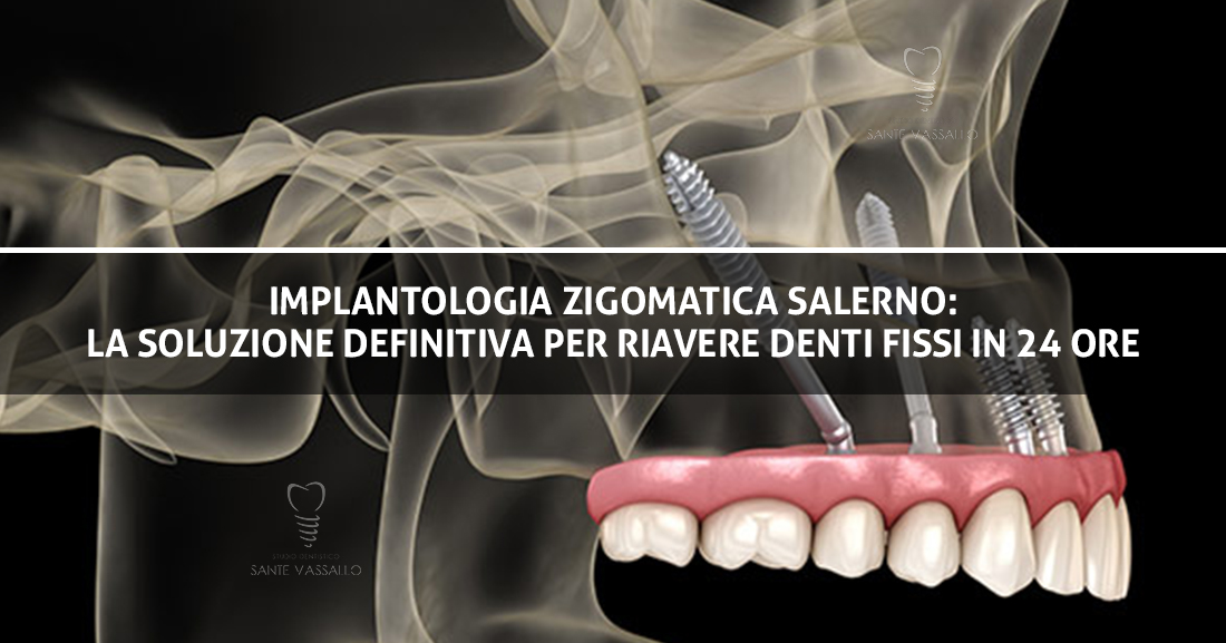 Implantologia Zigomatica Salerno La soluzione Definitiva