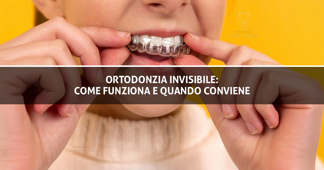 Ortodonzia Invisibile - Studio Dentistico Sante Vassallo