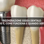 Rigenerazione Ossea Dentale Cos’è, Come Funziona e Quando Serve - Copertina