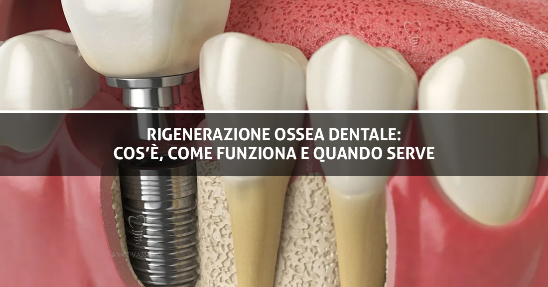 Rigenerazione Ossea Dentale Cos’è, Come Funziona e Quando Serve - Copertina